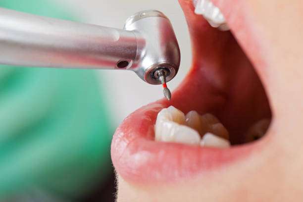 Best Emergency Dental Extractions in Owings Mills, MD